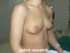 plastic-surgery-breast-augmentation 